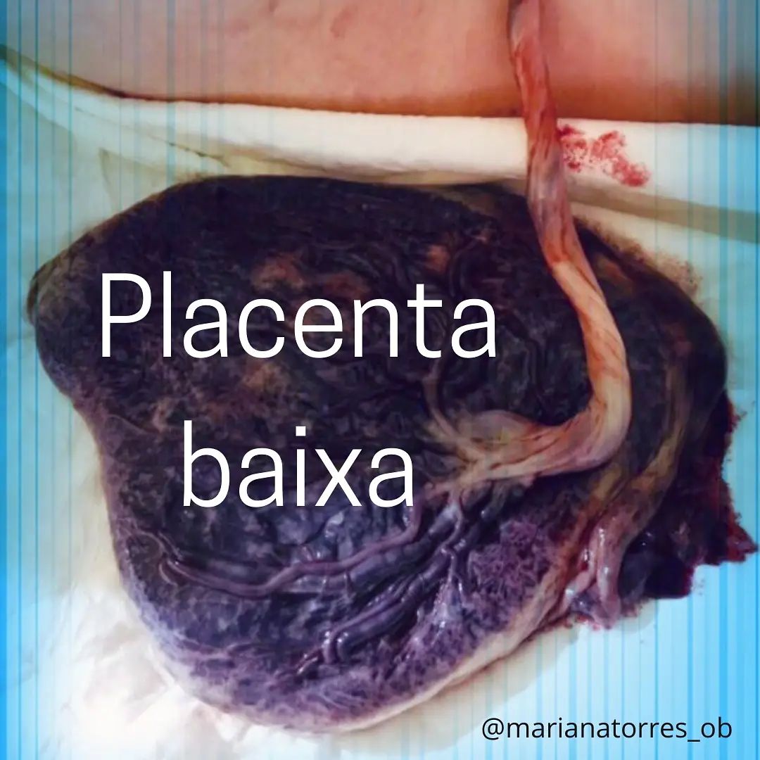 placenta baixa
