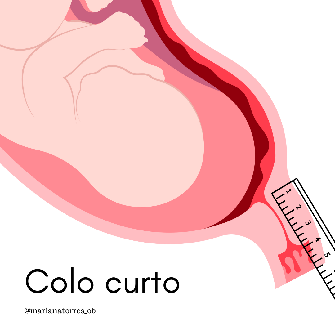 Colo uterino curto