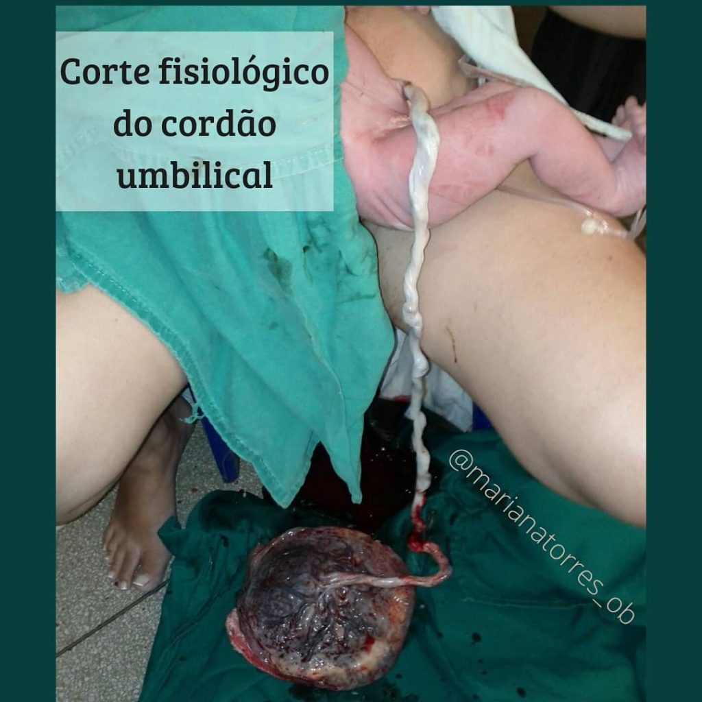 corte fisiologico do cordão umbilical