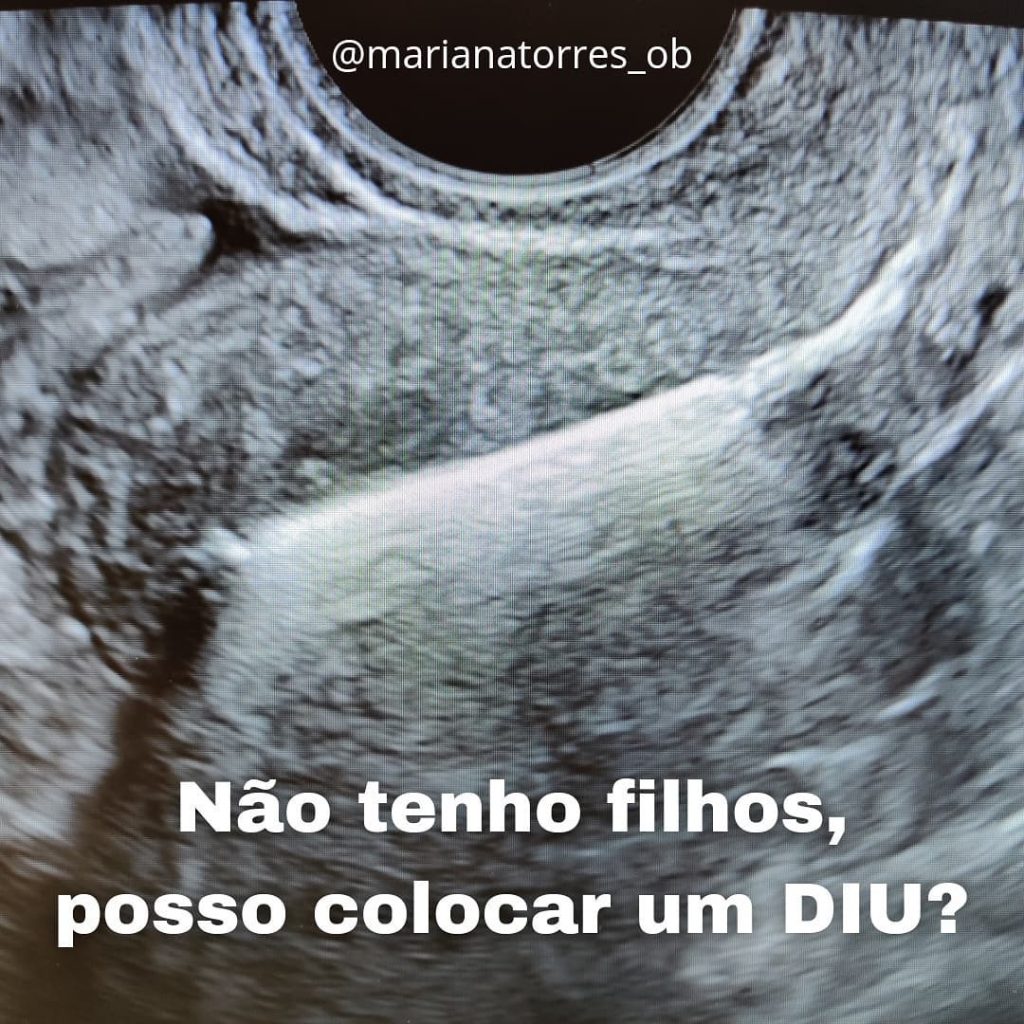 ecografia diu de cobre - nao tenho filhos, posso colocar um diu?