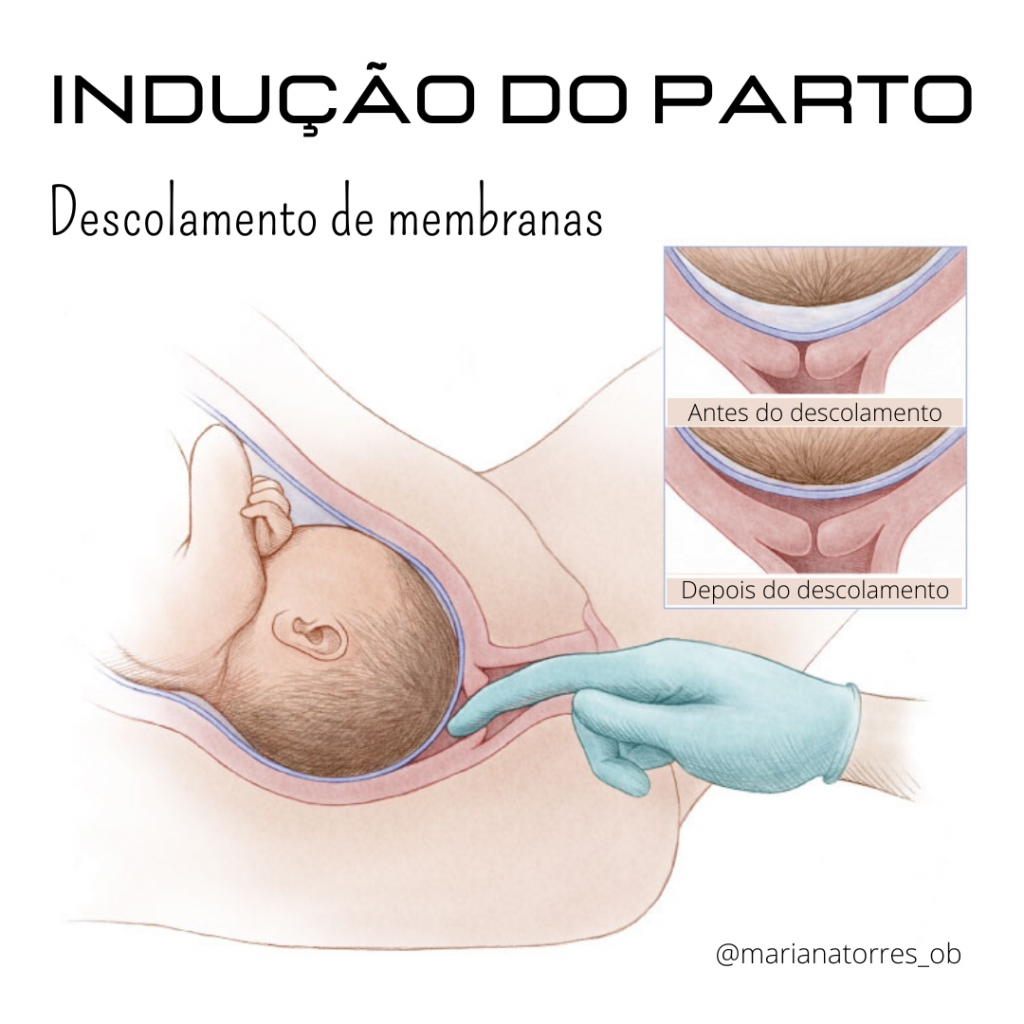 antes e depois do descolamento de membranas