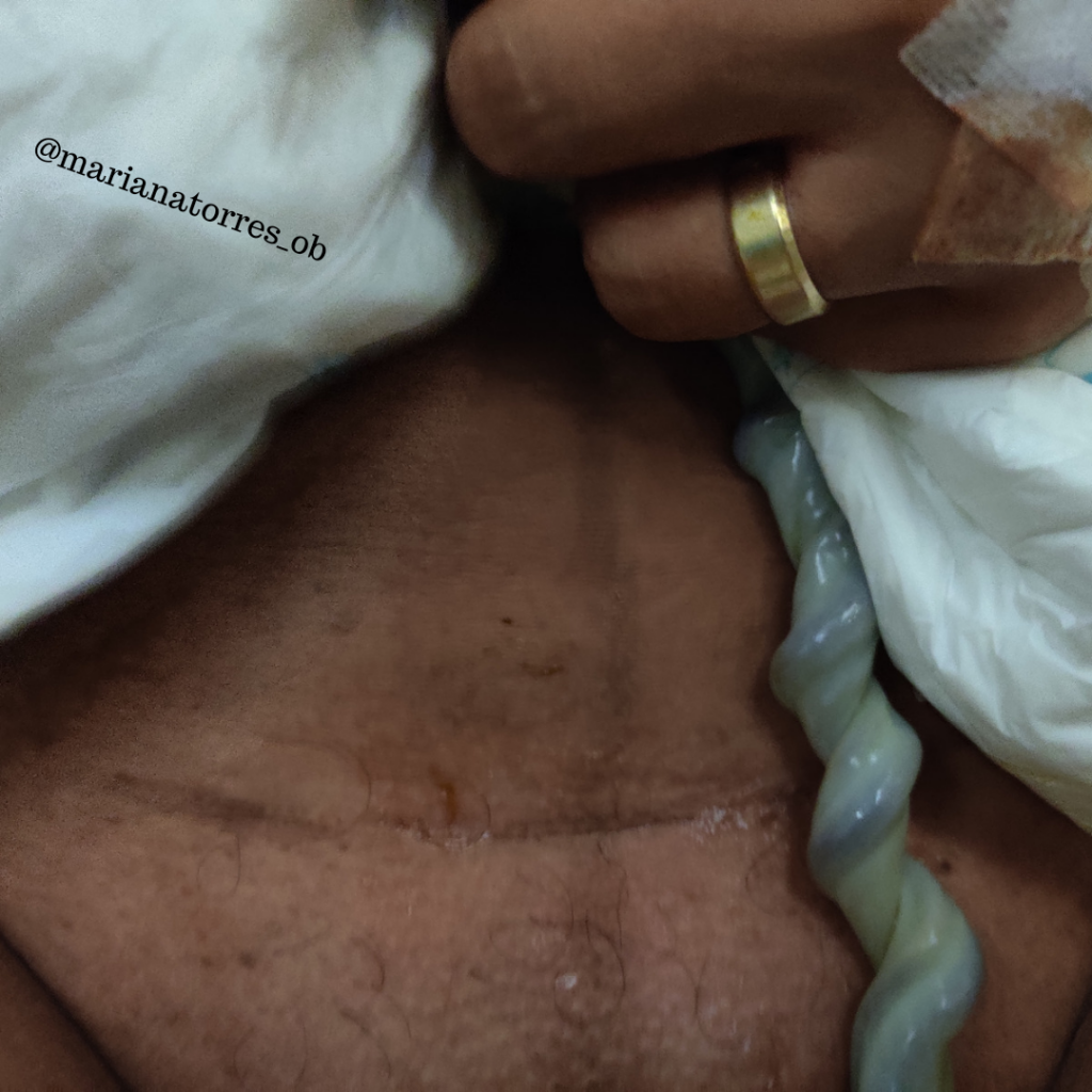 puerpera com cicatriz de cesariana depois de vbac, ainda com cordão ligado