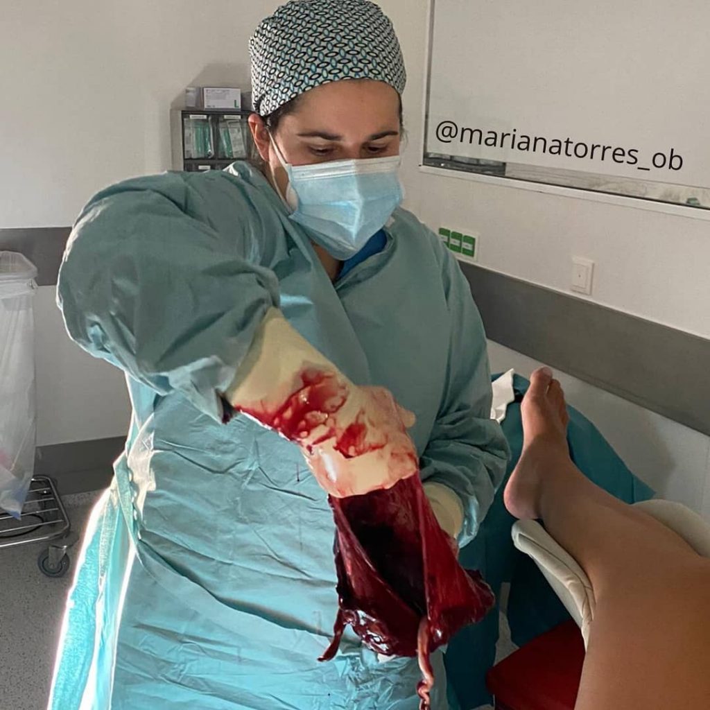 Obstetra a segurar a placenta após o parto