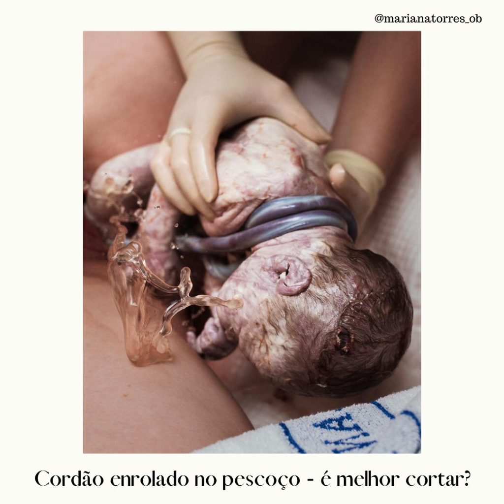 parto vaginal com dupla circular de cordão